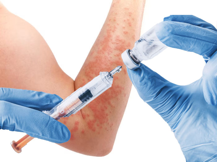 Dermatite allergica da contatto sistemica dopo vaccinazione influenzale contenente formaldeide - Grandeinganno