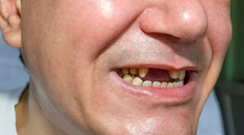 Inizia la sperimentazione del farmaco che fa ricrescere i denti: il primo tentativo al mondo di rigenerare i denti mancanti - Grandeinganno