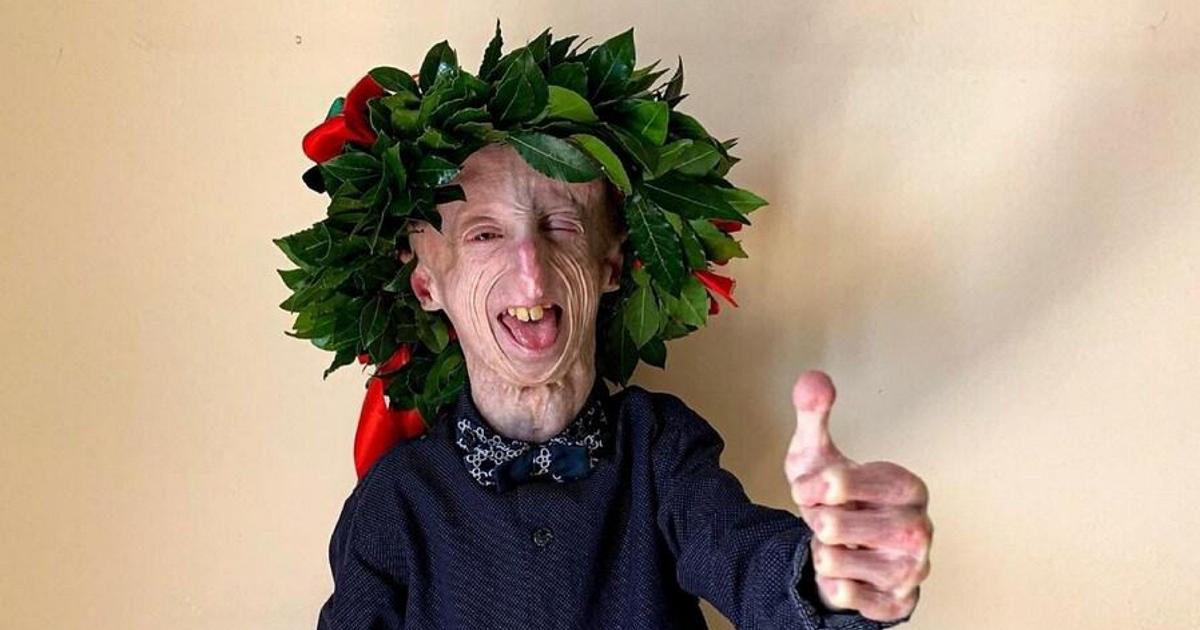 È morto Sammy Basso, il malato di progeria il più longevo al mondo