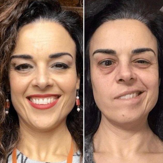 Vaccino Covid, Emilia Padovano Invalida e con Paralisi di Bell dopo 2 Dosi Pfizer, Riconosciuto Nesso di Causa ma lo Stato Non Indennizza!